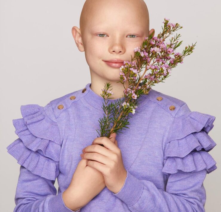 Photo Amanda Akokhia: Instagram - “If my body needs hair it will stay and if it doesn’t it will go. So let’s just go with the flow. From that day I accepted alopecia”. - @niamhbaldisbeautiful