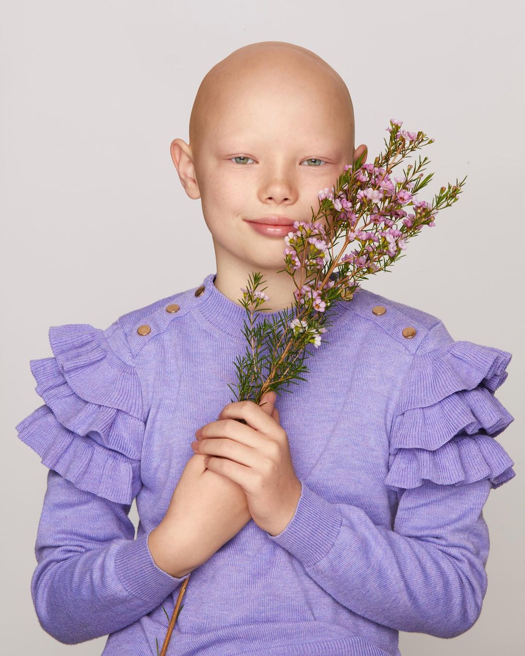 Photo Amanda Akokhia: Instagram - “If my body needs hair it will stay and if it doesn’t it will go. So let’s just go with the flow. From that day I accepted alopecia”. - @niamhbaldisbeautiful